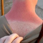 sunburn